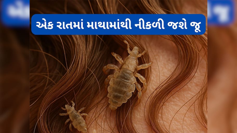 Head Lice: એક રાતમાં નીકળી જશે માથામાંથી જૂ, અજમાવી જુઓ નાળિયેર તેલનો આ નુસખો