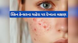  આવા ખીલ હોય શકે સ્કિન કેન્સરની શરુઆતનું લક્ષણ, લાંબો સમય ઈગ્નોર કરવાથી બગડશે હાલત
