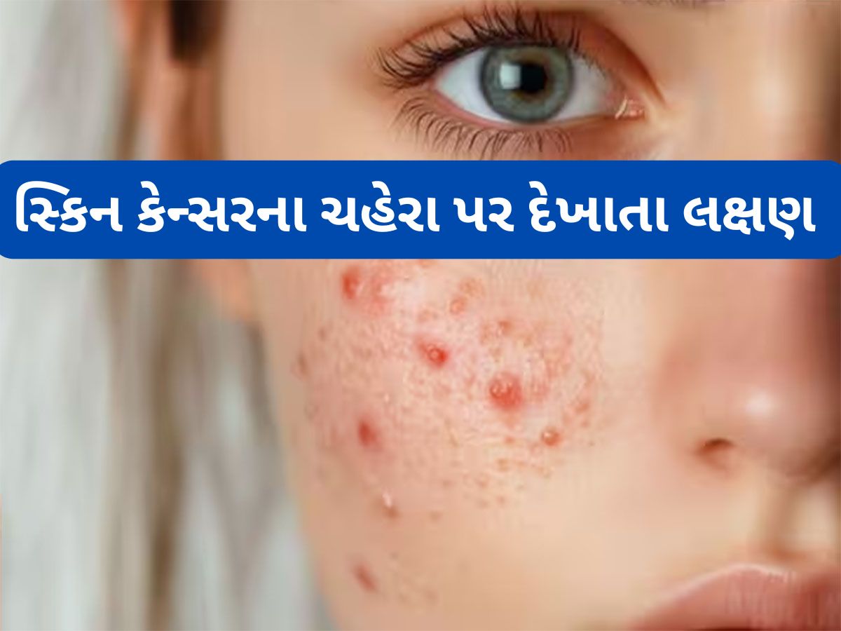 Skin Cancer Signs: આવા ખીલ હોય શકે છે સ્કિન કેન્સરની શરુઆતનું લક્ષણ, લાંબો સમય ઈગ્નોર કરવાથી બગડી જશે હાલત Skin Cancer Signs: આવા ખીલ હોય શકે છે સ્કિન કેન્સરની શરુઆતનું લક્ષણ, લાંબો સમય ઈગ્નોર કરવાથી બગડી જશે હાલત