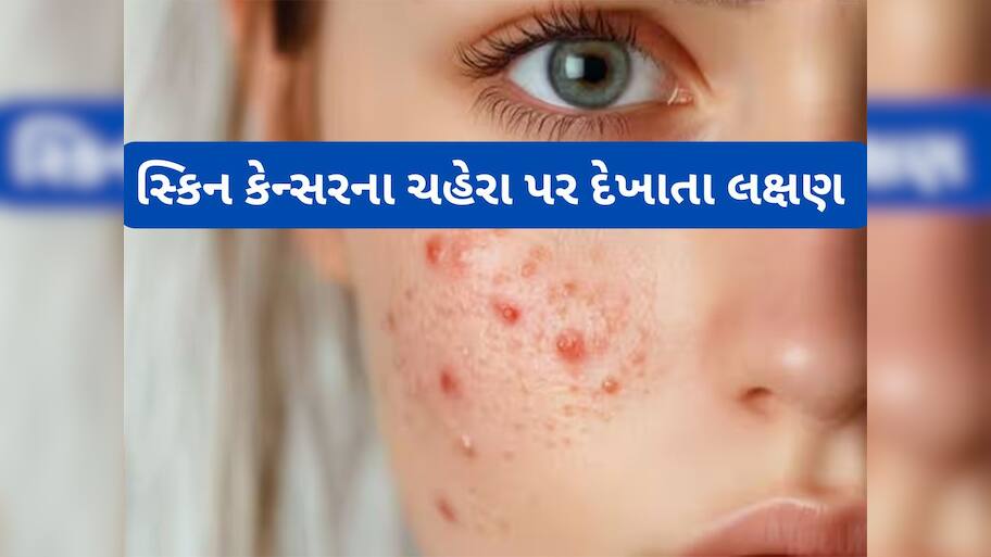 Skin Cancer Signs: આવા ખીલ હોય શકે છે સ્કિન કેન્સરની શરુઆતનું લક્ષણ, લાંબો સમય ઈગ્નોર કરવાથી બગડી જશે હાલત