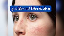 Dry Skin: ઠંડીના કારણે ગાલ ફાટે તો આ વસ્તુ લગાડજો, એક દિવસમાં સ્કિન થઈ જશે સોફ્ટ