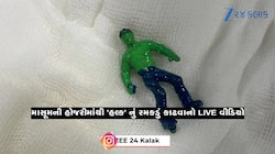 ઓપરેશનનો LIVE વીડિયોઃ અમદાવાદની સિવિલમાં દોઢ વર્ષના વંશની હોજરીમાંથી કઢાયો 'હલ્ક'