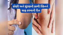 ઘુંટણ-કોણીની કાળી સ્કિન 7 દિવસમાં નોર્મલ થઈ જશે, દિવસમાં 2 વખત લગાડો આ વસ્તુ
