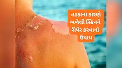 તડકામાં સ્કિન બળી જવી અને સ્કિન ટેન થવી બંને અલગ, જાણો સનબર્નમાં સ્કિન પર શું લગાડવુ