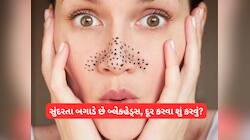 ચાંદ જેવા ચહેરાને બગાડી નાખે છે બ્લેકહેડ્સ, જાણો કેમ થાય અને દૂર કરવા શું કરવું?