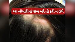 આ રીતે વાળ ખરે તો ક્યારેય પાછા ન ઉગે, જાણો વાળના મૂળનો નાશ કરી નાખે તેવા રોગ વિશે
