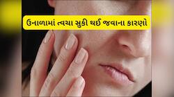 ઉનાળામાં સ્કિન ફાટવાનું કારણ જાણો, સ્કિનની ડ્રાયનેસ દુર કરવા લગાડો આ સફેદ વસ્તુ