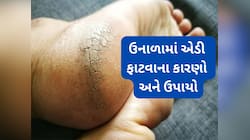 2 કારણોને લીધે ઉનાળામાં પણ એડી ફાટે, એડીની સ્કિનને રિપેર કરવા યુઝ કરો આ 3 વસ્તુઓ