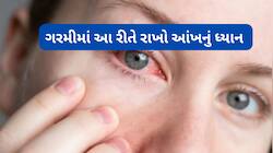 Eye Care Tips: અતિશય ગરમીના કારણે આંખમાં થતી સમસ્યાઓના ઘરેલુ ઉપાયો