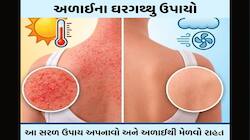 ગરમીના કારણે નીકળતી અળાઈથી રાહત આપે તેવા ઘરેલુ ઉપાયો, નાના-મોટા સૌ કોઈ કરી શકે ટ્રાય