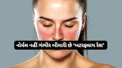 ચહેરા પર પતંગિયાના શેપમાં રેશ થાય તો નોર્મલ ન ગણો, આ છે ગંભીર બીમારીનું પહેલું લક્ષણ