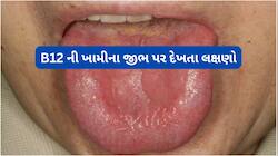 વિટામિન બી12 ની ખામીના જીભ પર દેખાતા લક્ષણો, બી12 ઓછું હોય તો આંખને થાય ગંભીર નુકસાન