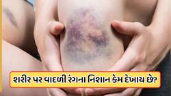ઈજા વગર શરીર પર દેખાય છે વાદળી નિશાન? જાણો કઈ ગંભીર બીમારીનું હોઈ શકે છે કારણ