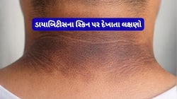 ડાયાબિટીસના સૌથી પહેલા લક્ષણો દેખાય છે શરીરના આ ભાગમાં, આ ફેરફારને ઈગ્નોર કરતાં નહીં