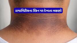 ડાયાબિટીસના સૌથી પહેલા લક્ષણો દેખાય છે શરીરના આ ભાગમાં, આ ફેરફારને ઈગ્નોર કરતાં નહીં