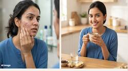 Pimples: ગાલ પર ખીલ વધી ગયા છે ? થોડા દિવસ આ પાણી પીવો, ખીલના નામોનિશાન મટી જશે