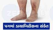  Diabetes Symptoms: પગમાં આ રીતે મળે છે ડાયાબિટીસની ચેતવણીના સંકેત, એક્સપર્ટે જણાવ્યું ક્યારે કરાવવો સુગર ટેસ્ટ