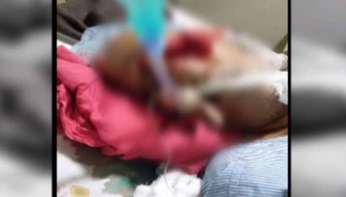 ગાંધીનગર સિવિલ હોસ્પિટલમાં દર્દીને ઉંદર કરડ્યાની પરિજનોની ફરિયાદ