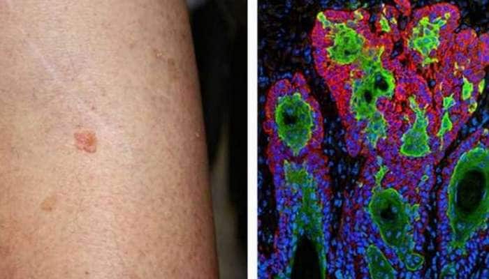Skin Cancer ની સારવારમાં ભારતીય વૈજ્ઞાનિકોને મળી મોટી સફળતા