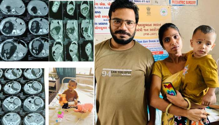 Ahmedabad: 18 માસની બાળકીના પેટમાંથી દૂર કરાયું 400 ગ્રામનું અવિકસિત ભ્રુણ, બાળકીને મળ્યું નવજીવન