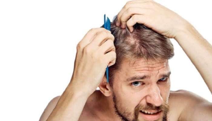 Tips for Hair Care: માથામાં જૂ પડી ગઈ છે તો ફીકર નોટ, બસ આ ઉપાય કરો જૂ થઈ જશે છુમંતર