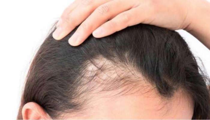 HAIR FALL: જડમૂળથી ગાયબ થઈ રહ્યા છે માથાના વાળ? માથાના વાળ બચાવવા હોય તો આટલું કરો