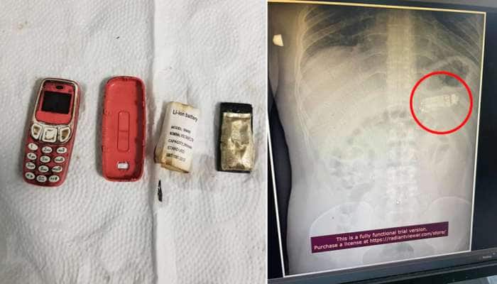Nokia ફોન ગળી ગયો આ વ્યક્તિ, ડોક્ટરે X-Ray જોયો તો પેટની સ્થિતિ જોઈને સ્તબ્ધ થઈ ગયા