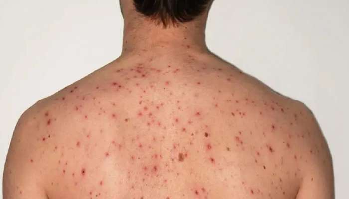 Body Acne: શરીર પરના ખીલથી છુટકારો મેળવવા માટે સવારે અને રાત્રે અનુસરો આ Tips