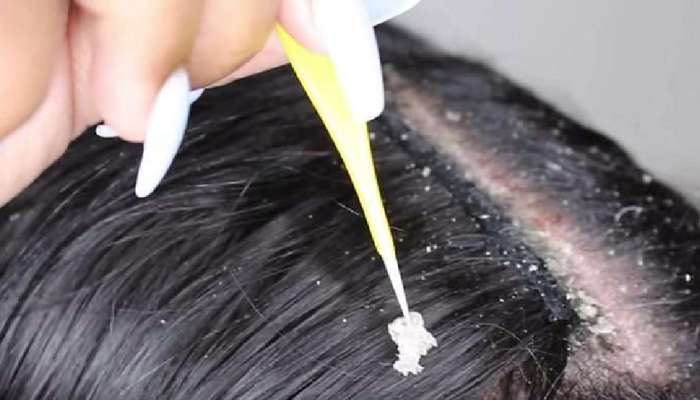Tips for remove dandruff: આ 4 વસ્તુઓ ડેન્ડ્રફને જડમાંથી દૂર કરી શકે છે, જાણો ઉપયોગ કરવાની સાચી રીત