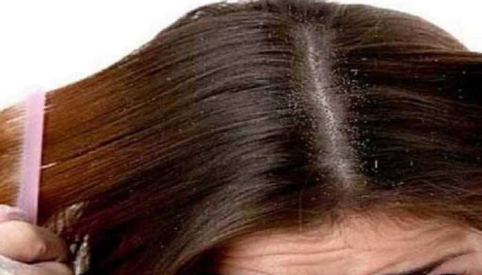 Dandruff થી પરેશાન છો? કેમ થાય છે આ સમસ્યા? જાણો કાયમી ઈલાજ