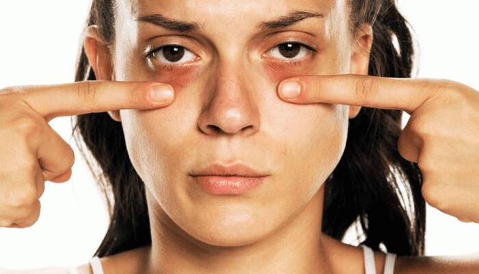 Dark Circles ની સમસ્યા સતાવે છે? ફિકર નોટ..આ ઉપાયથી થઈ જશે સમસ્યાનું સમાધાન