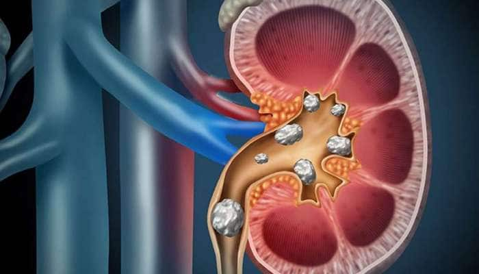 અચાનક પથરીનો દુઃખાવો થાય તો શું કરવું? ઓપરેશન વિના કેવી રીતે થઈ શકે પથરીનો ઈલાજ