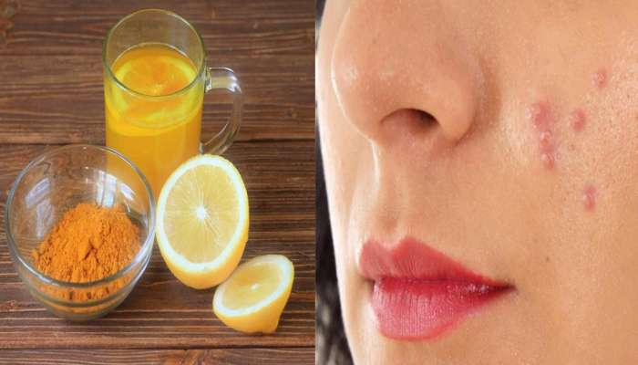 વારંવાર ચહેરા પર કેમ થાય છે ખીલ? ખીલની સમસ્યાનું કેવી રીતે કરવું કાયમી નિરાકરણ જાણો