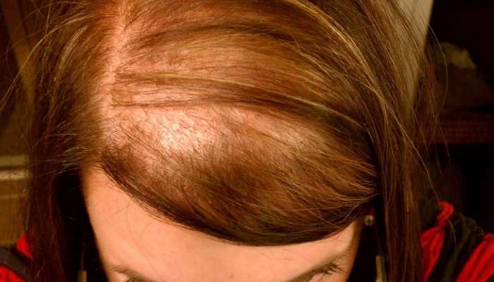 Hair Fall in Women: હેરફોલથી બચવા મહિલાઓ અપનાવે આ ખાસ ઉપચાર, દૂર થશે સમસ્યા