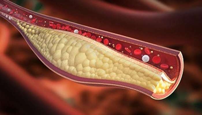 High cholesterol warning Signs: શરીરમાં કોલેસ્ટ્રોલ વધવાના આ 5 વોર્નિંગ ચિહ્નો, હળવાશમાં લેવાની ના કરતા ભૂલ High cholesterol warning Signs: શરીરમાં કોલેસ્ટ્રોલ વધવાના આ 5 વોર્નિંગ ચિહ્નો, હળવાશમાં લેવાની ના કરતા ભૂલ
