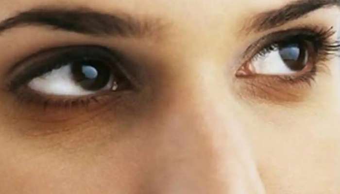 Diabetes Sings On Skin: ડાર્ક સર્કલ્સ છે આ ખતરનાક બીમારીનું એક લક્ષણ, હળવાશમાં લેવાની ના કરતા ભૂલ