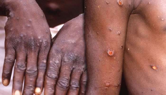 Monkeypox Virus: કોરોના ગયો નથી ત્યાં નવા વાયરસે ચિંતા વધારી, બ્રિટન બાદ હવે આ દેશમાં મળ્યો કેસ