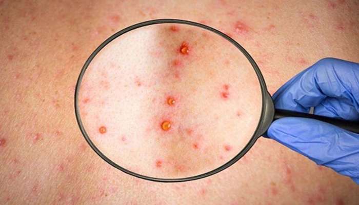 Monkeypox: વિશ્વના અનેક દેશોમાં ફફડાટ! ભારતમાં ટેસ્ટ માટે લોન્ચ કરાયું RT-PCR, ઘરે બેસીને કરી શકશો તમારો ટેસ્ટ