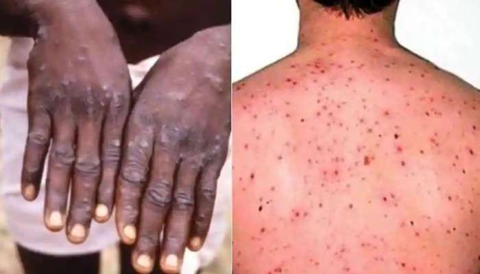 Monkeypox: 29 દિવસમાં 30થી વધુ દેશોમાં લગભગ 600 કેસ, ભારતમાં પણ એલર્ટ