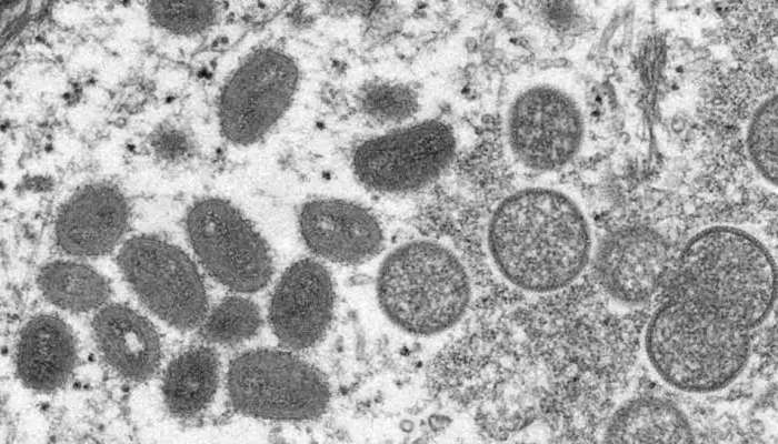Monkeypox: 67 દેશોમાં ફેલાયો આ વાયરસ, યૂરોપમાં 2 અઠવાડિયામાં 3 ગણા કેસ