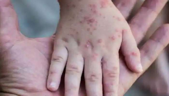 દિલ્હીમાં મંકીપોક્સનો પ્રથમ કેસ સામે આવ્યો, હિમાચલથી ફરીને આવ્યો હતો વ્યક્તિ