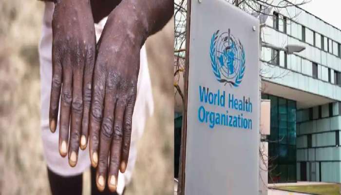 મંકીપોક્સે ચિંતા વધારી, WHOએ કહ્યું- તેને હળવાશથી ન લો, તકેદારી વધારો