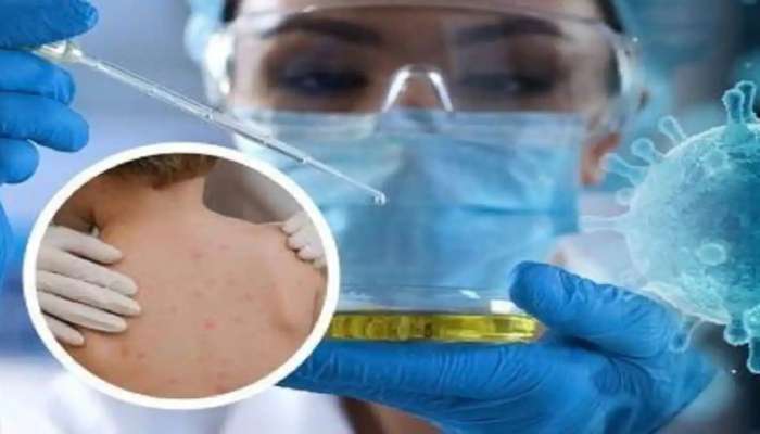 મંકીપોક્સ વિરુદ્ધ જંગની તૈયારીમાં સરકાર, વેક્સીન બનાવવા બહાર પાડ્યું ટેન્ડર