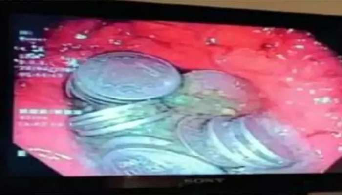 પેટમાં દુ:ખાવો થતા ડોક્ટર પાસે ગયો વ્યક્તિ, એક્સરેમાં જે જોવા મળ્યું..જોઈને થથરી જશો