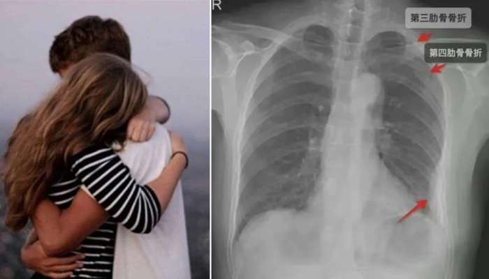 હાડકાં તોડ HUG: છોકરીને એવું ટાઇટ HUG કર્યું કે તૂટી ગઇ પાંસળીઓ, અને પછી...