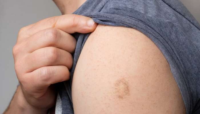 WHO નો ખુલાસો: મંકીપોક્સની વેક્સીન નથી 100 ટકા અસરકારક? પોતાને વાયરસથી બચાવો