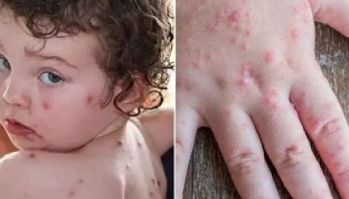 Tomato Flu થી થઈ જાવ સાવધાન... કેન્દ્રએ જાહેર કરી ગાઇડલાઇન, જાણો તમામ વિગત