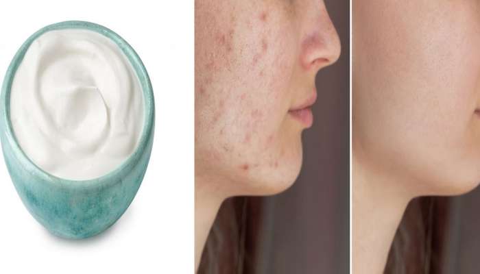 How To Get Rid Of Scars: હટી જશે બધા ડાઘા અને સ્કિન ચમકશે કાચ જેવી, માત્ર અપનાવો આ ઘરેલું ઉપાય
