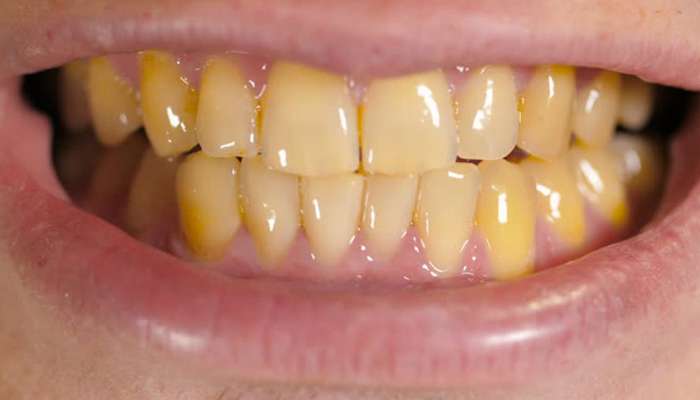 તમારા દાંતને પીળા કરી દેતી બીમારી શું છે અને સારવાર કેવી રીતે થાય છે?