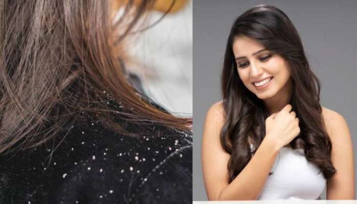 Dandruff Treatment: ફક્ત 10 રૂપિયામાં ખતમ થશે ડેંડ્રફવાળા વાળ, અપનાઓ આ ઘરેલૂ નુસખા